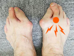 ヘバーデン結節が原因となる足指の「第２指付け根の痛み」