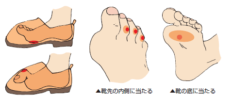 浮き指状態の足の説明