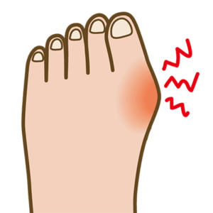 外反母趾と親指のしびれの関係性